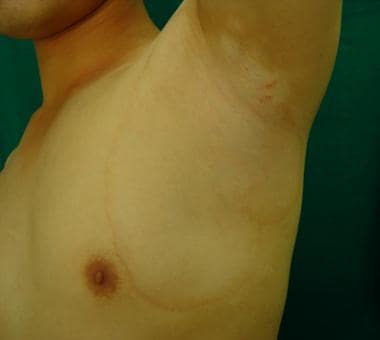 Marginal inflammatory vitiligo. 