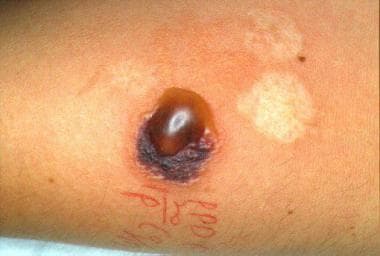 Cutaneous port-site recurrence. (A) Erythematous, indurated, hard