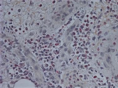 Photo illustrates leukocyte esterase staining of t