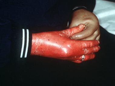 Inflexible fingers due to taut skin in a young pat