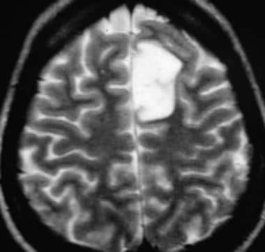 T2-weighted sequences of an MRI of the brain of a 
