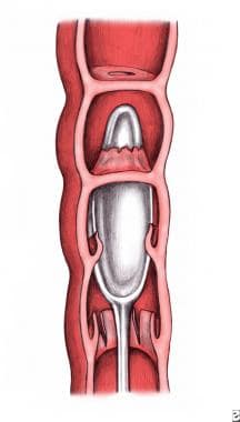 Illustration depicts the intraluminal appearance o