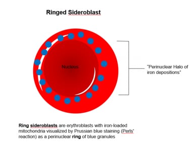 ringed sideroblasts