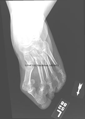 Anteroposterior radiograph showing hammertoe defor