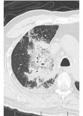 Pulmonary mucormycosis in a patient with SARS-CoV-