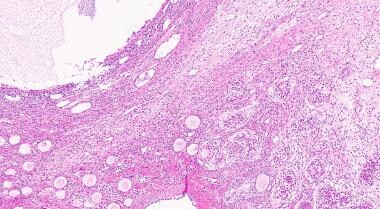 H&E stain of ovotestis demonstrating ovarian paren