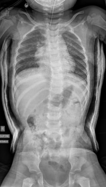 A brace to address functional 4-curve patterns for right thoracic