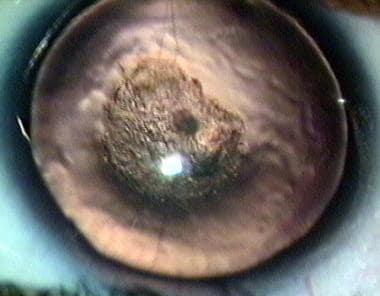 Centrally placed cataractous lens and aniridia in 
