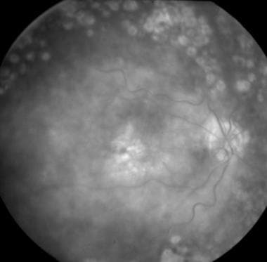 Fluorescein angiogram of the same patient with cen