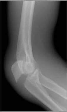 Typical relatively transverse olecranon fracture. 