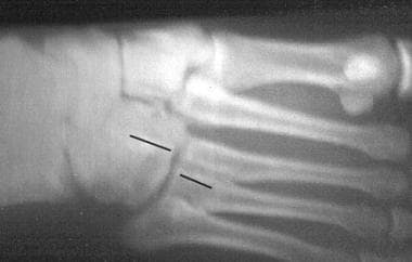 In this medial oblique radiograph of a Lisfranc in