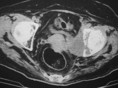 Axial computed tomography scan shows a destructive