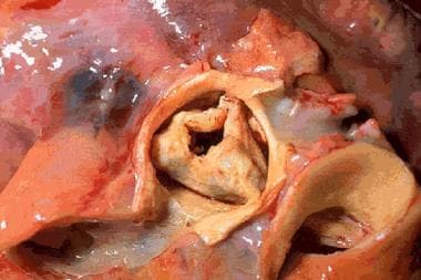 Stenotic aortic valve (macroscopic appearance). 