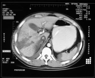 Blunt abdominal trauma with liver laceration. 