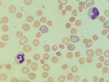 hemolytic disease of the newborn blood smear