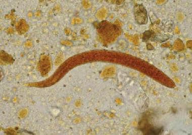 Rhabditiform larva of Strongyloides stercoralis in