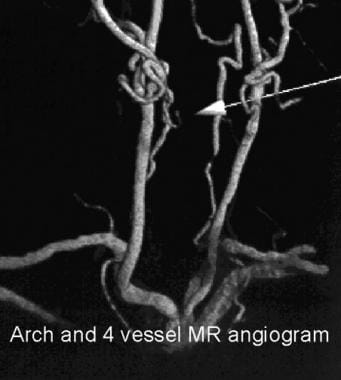 Magnetic resonance angiography (MRA) with 3-dimens