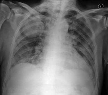 Chest radiograph showing a dense, large, right upp