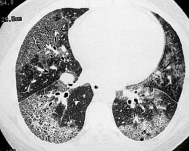 High-resolution CT scan of the same patient in the