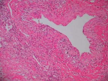 Lung biopsy specimen from a patient with granuloma