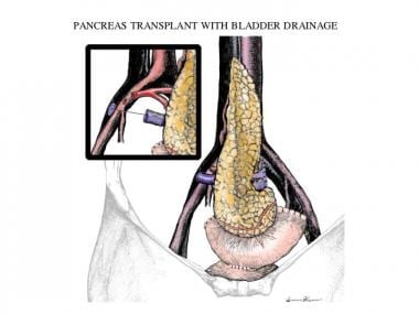 Solitary pancreas transplantation with bladder dra