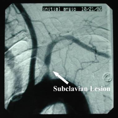 Irregular proximal subclavian stenosis. 