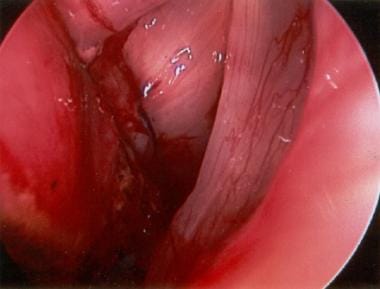 Direct laryngoscopic view of a lateralized left tr