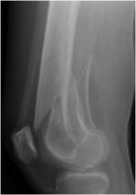 Radiograph of an intra-articular distal femur frac