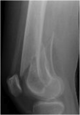 left comminuted distal femur fracture icd 10