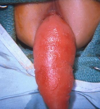 Photograph of severe rectal prolapse with clinical