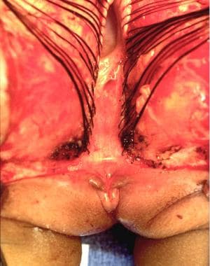 Repair of persistent cloaca with 3-cm common chann