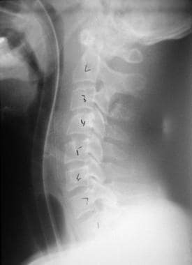 C3棘突骨折的侧面视图。
