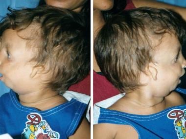 Lateral views of 2-year-old boy with Treacher Coll