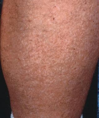 Confetti skin lesions are hypomelanotic lesions th