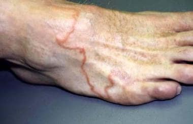 roundworm in humans skin