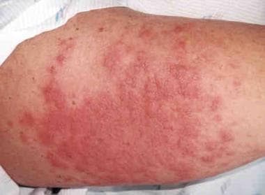 Nonspecific Skin Rash  Saint Luke's Health System