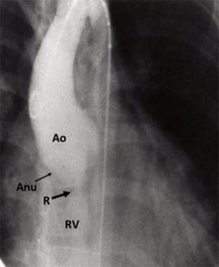 Sinus of Valsalva aneurysm. Selected frame from ao
