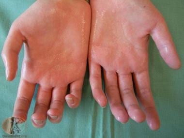 Hyperhidrosis of the palms. Courtesy of DermNet Ne