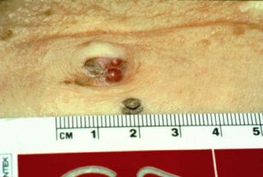 Sister Mary Joseph nodule in a patient with gastri