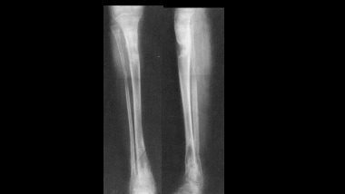 Growth plate (physeal) fractures. Equal leg length