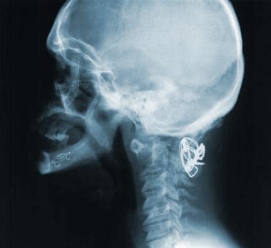 女性唐氏综合征侧位颈椎x线片