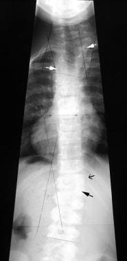 Congenital Spinal Deformity: Background, Embryology of Spine