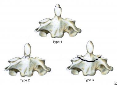 Three types of C2 odontoid fractures: type I is an