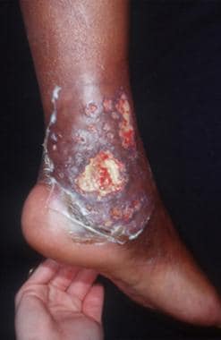 Benign Skin Lesions: Overview, Defining the Lesion, Papules and Plaques