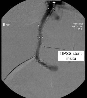 Transjugular intrahepatic portosystemic shunt (TIP