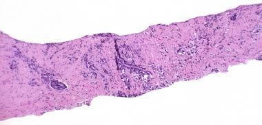 Postradiation Therapy Pathology of Prostate Cancer