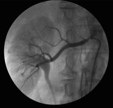 Percutaneous transluminal renal angioplasty in mid