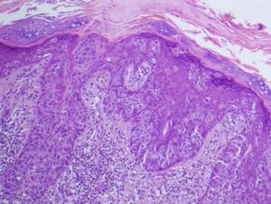 squamous cell carcinoma skin histology