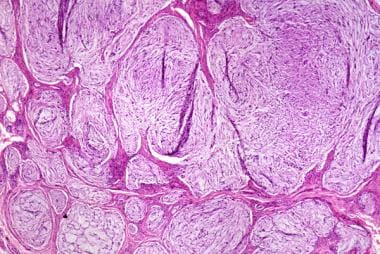 This myxoid neurothekeoma displays a lobulated, no