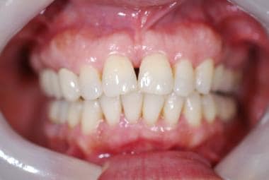 Preoperative view of a diastema. 